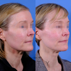 Facelift 5_R oblique closed