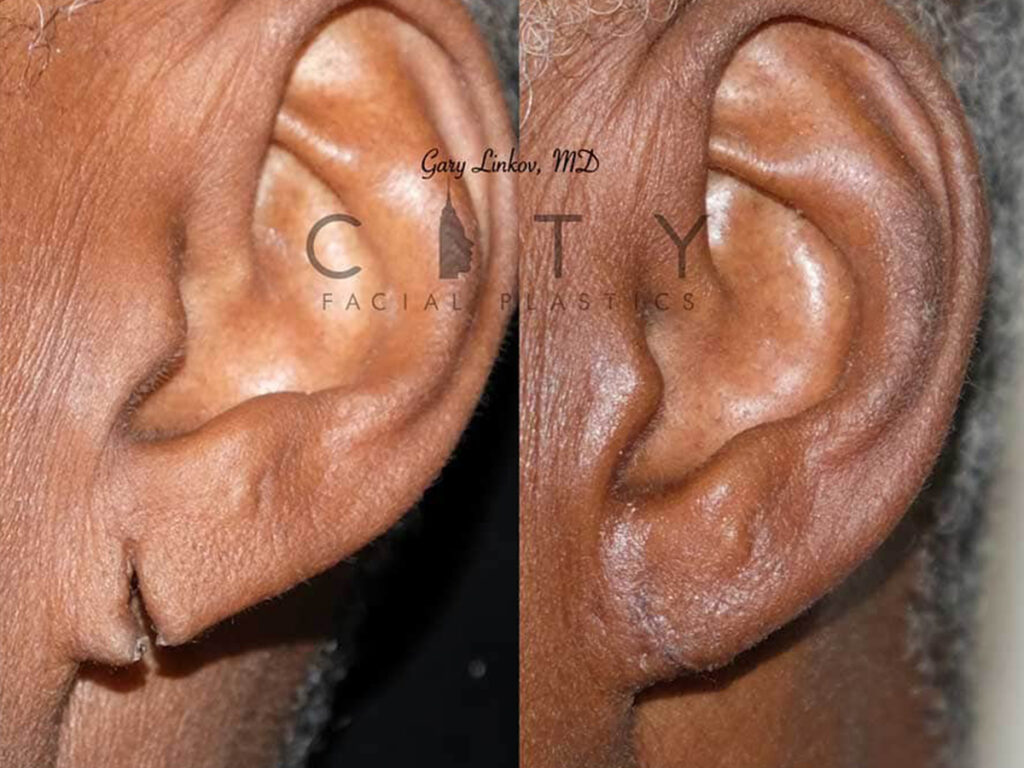 NYC Ear Lobe Repair Before and After Pictures New York UES