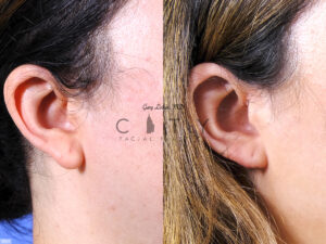 Ear-lobe-repair-D003-grid
