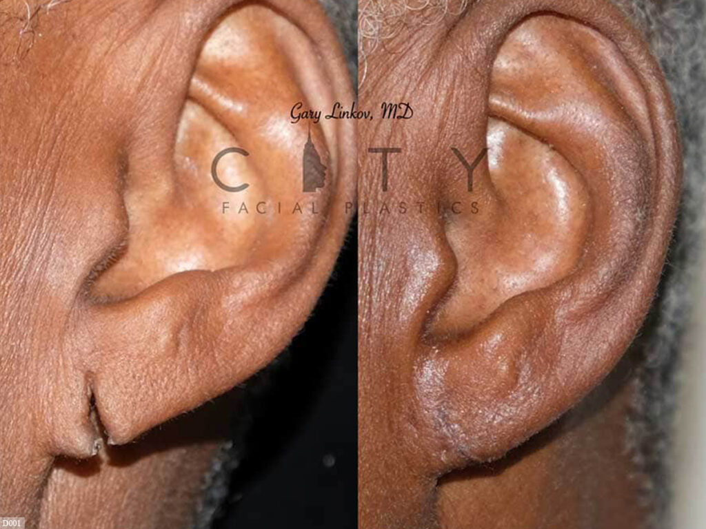 Ear lobe repair near me
