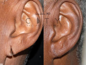 Ear-lobe-repair_D001-grid