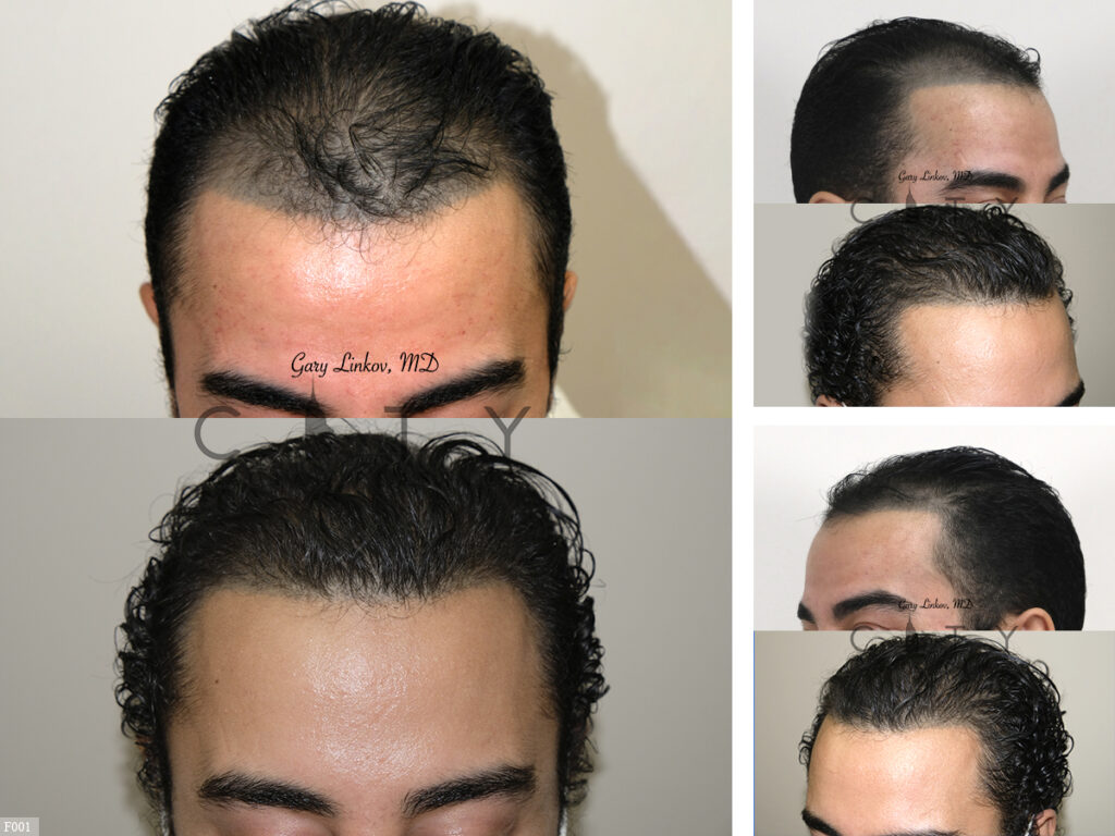 Hair-Transplant-F001_grid