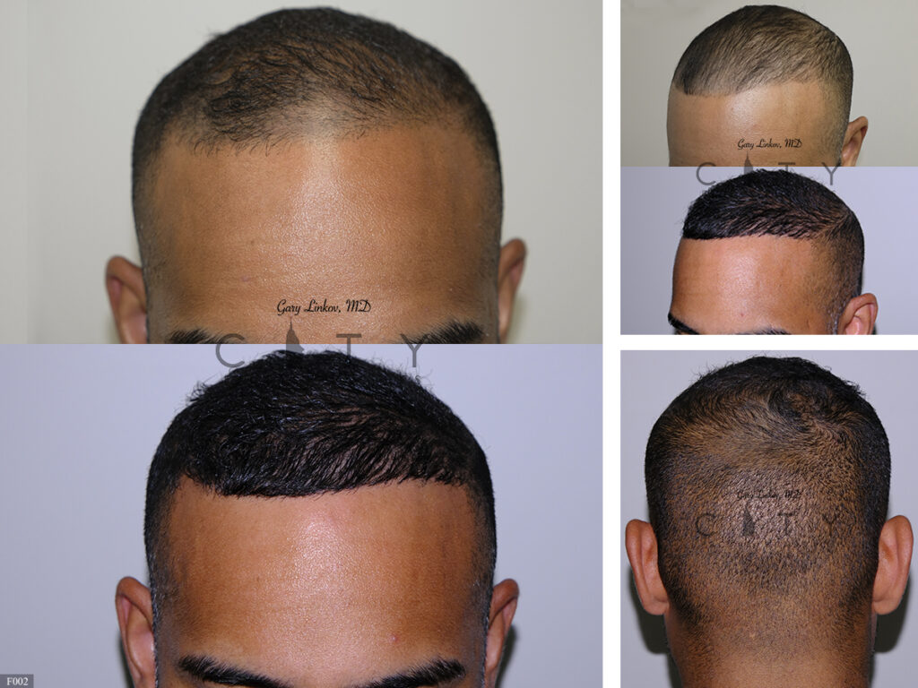 Hair-Transplant-F002_grid
