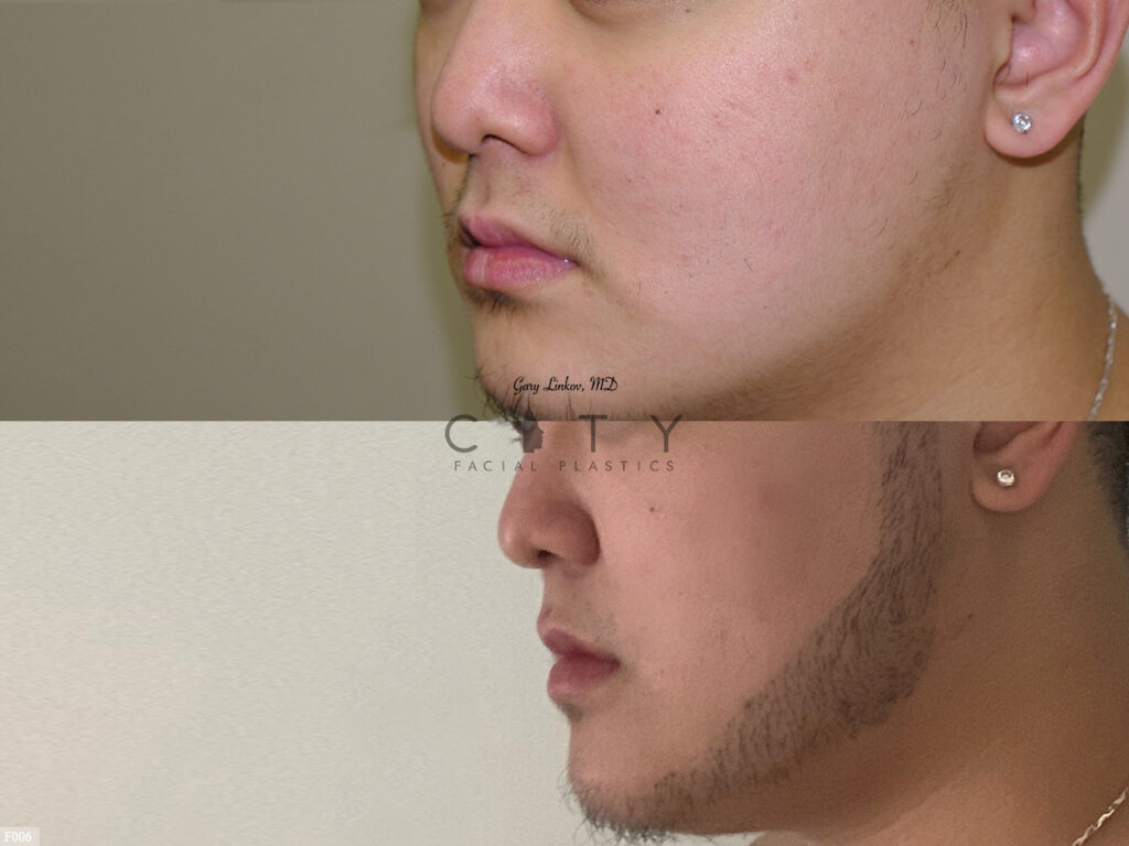 Hair-Transplant-F006_grid