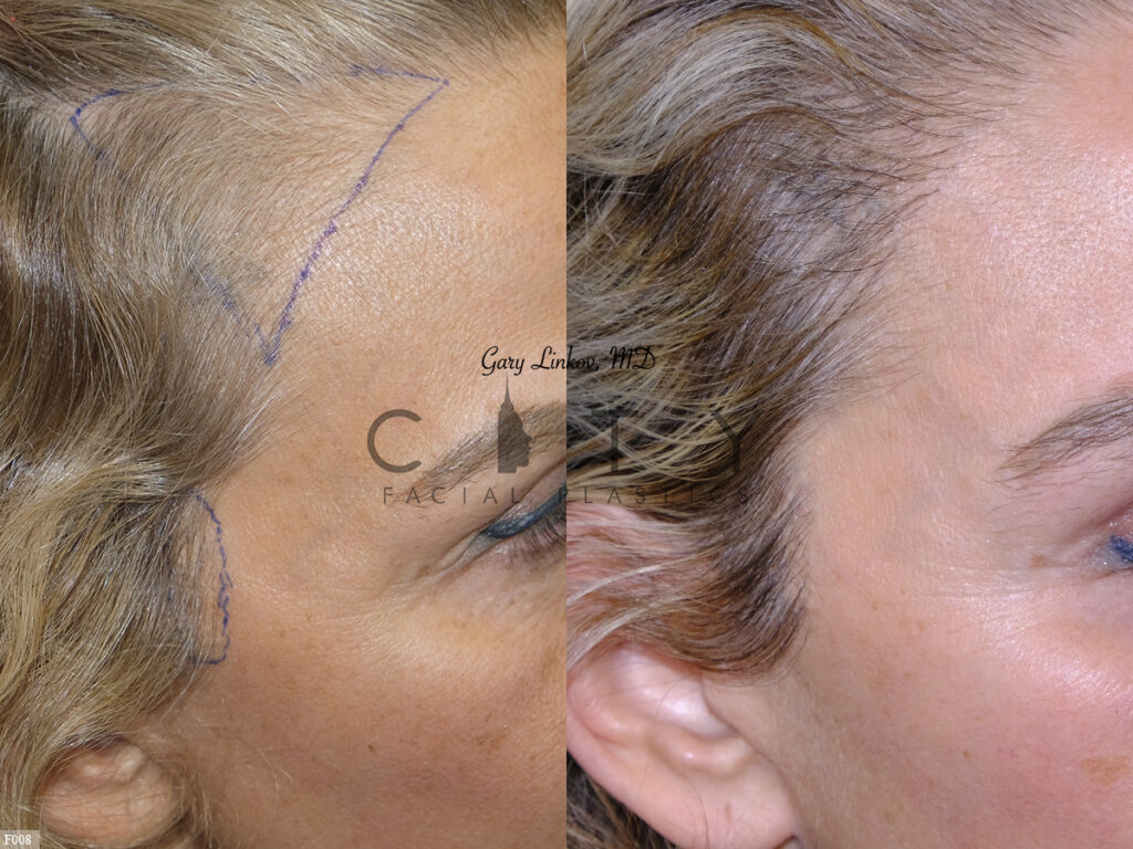 Hair-Transplant-F008_grid