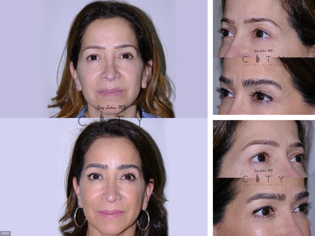 Hair-Transplant-F009_grid