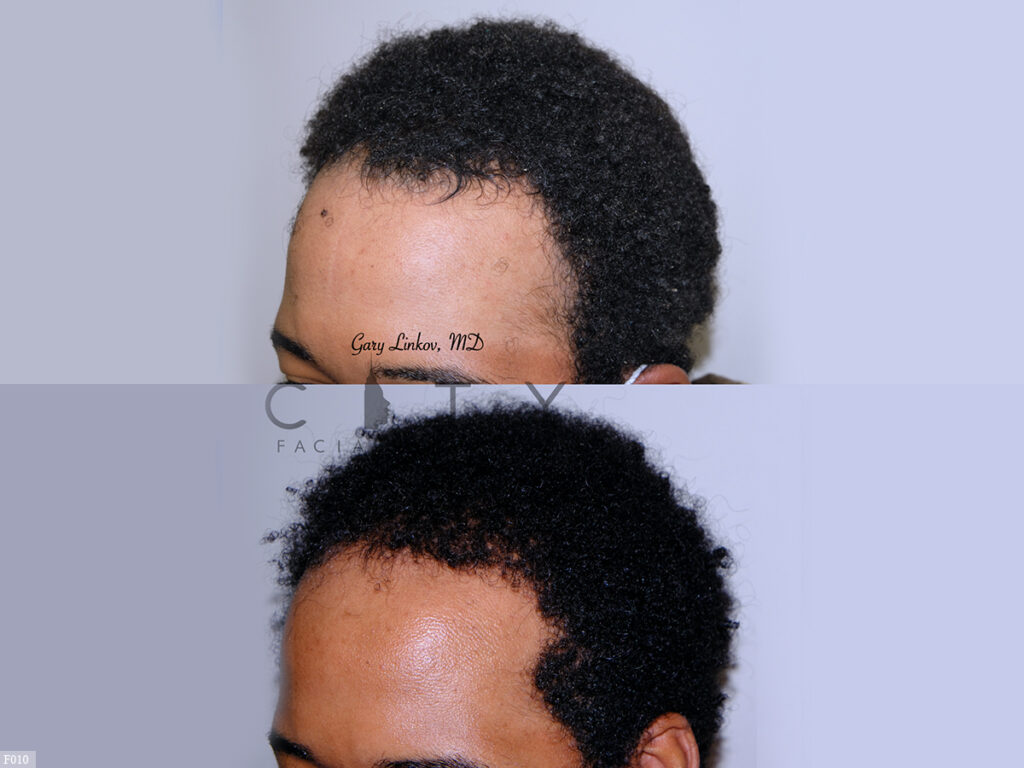 Hair-Transplant-F010_grid