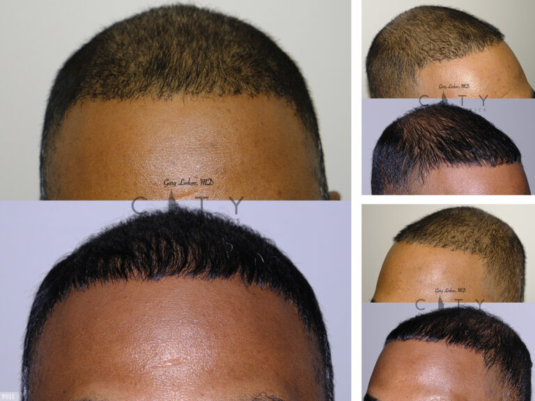 NYC Hair Transplant Photo Gallery Before And After Pictures - New York ...