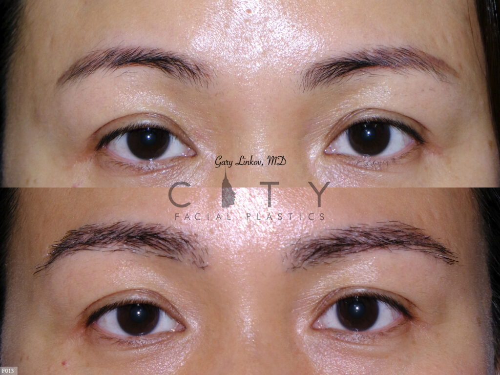 Hair-Transplant-F013_grid