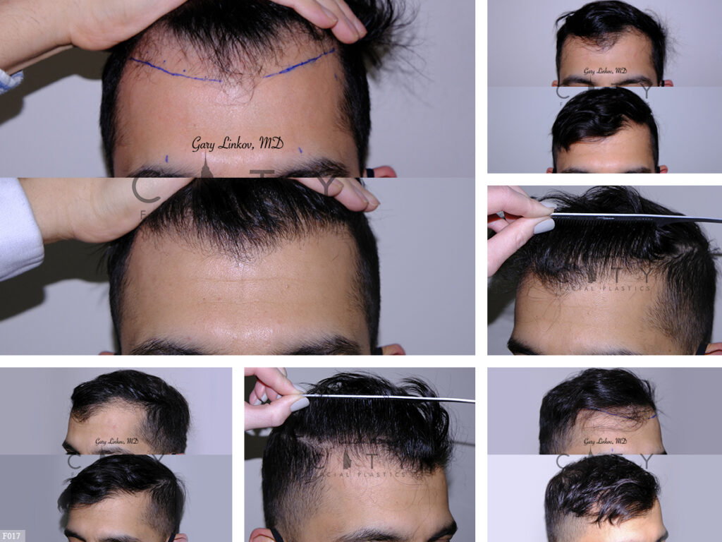 Hair-Transplant-F017_grid