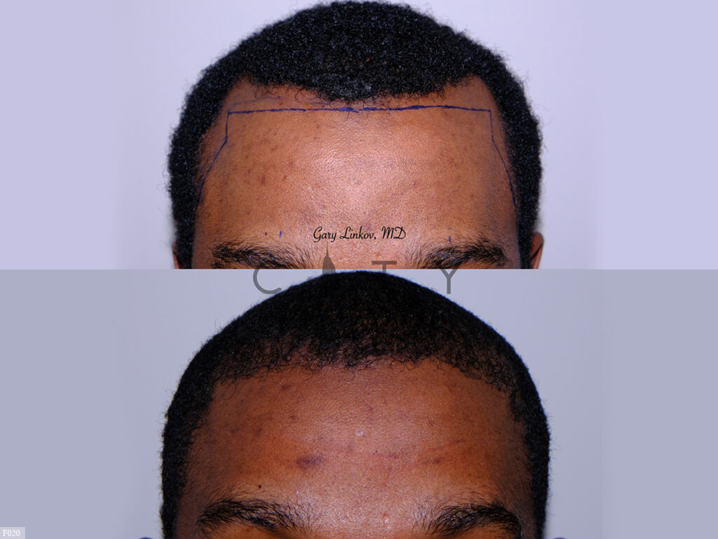 Hair-Transplant-F020_grid