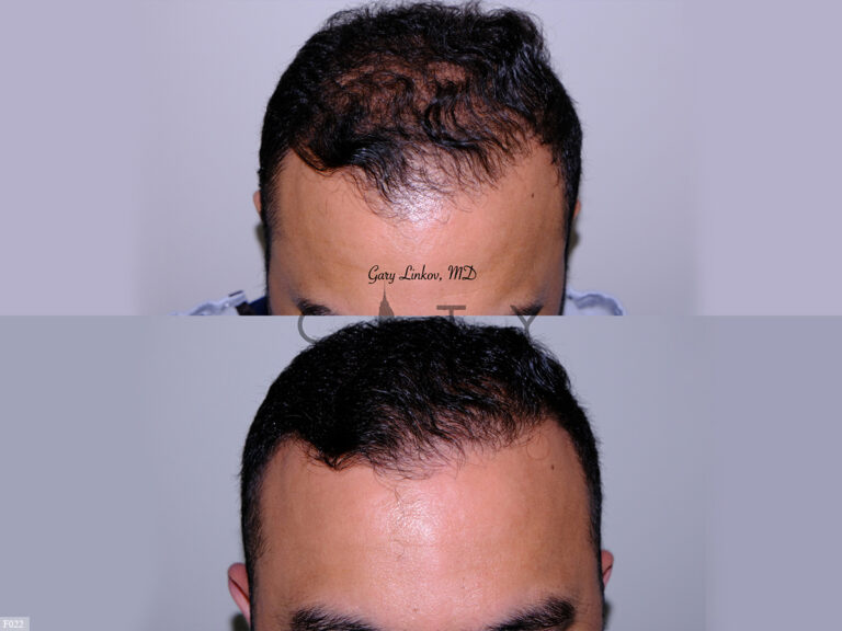 NYC Hair Transplant Photo Gallery Before and After Pictures New York