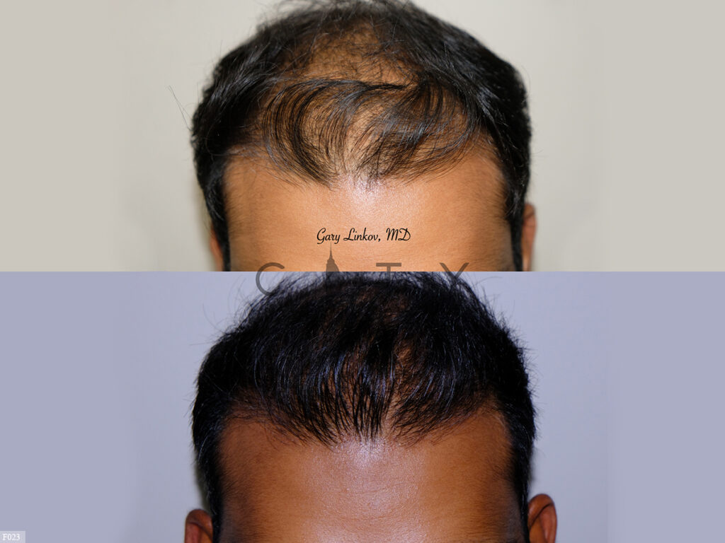 Hair-Transplant-F023_grid