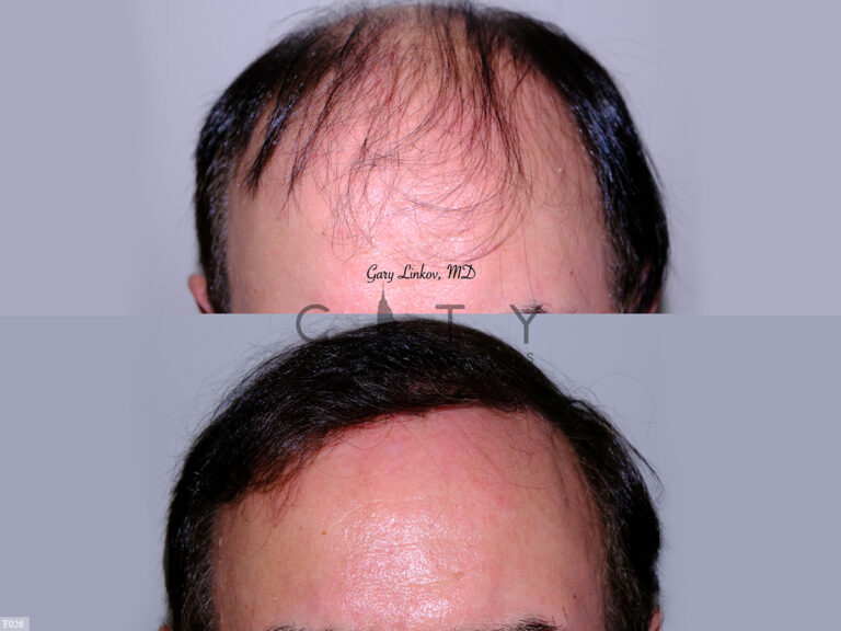 NYC Hair Transplant Photo Gallery Before And After Pictures - New York ...