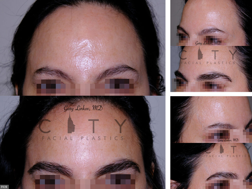 Hair-Transplant-F028_grid