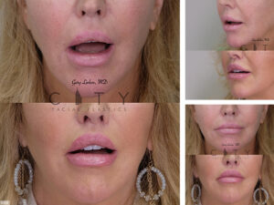 Lip-Lift-G006_grid