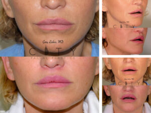 Lip-Lift-G015_grid