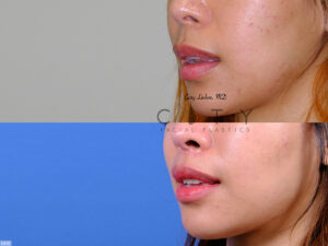 Lip-Lift-G020_grid