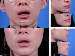 Lip-Lift-G024_grid