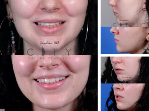Lip-Lift-G030_grid
