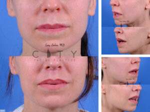 Lip-Lift-G031_grid