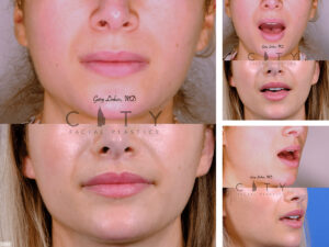 Lip-Lift-G034_grid