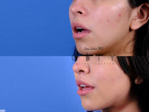 Lip-Lift-G050_grid