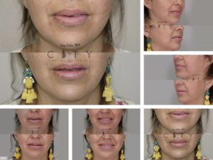 Lip-Reduction-H001_grid