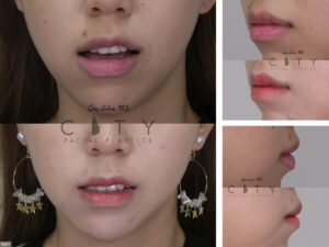 Lip-Reduction-H002_grid