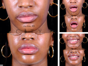 Lip-Reduction-H004_grid