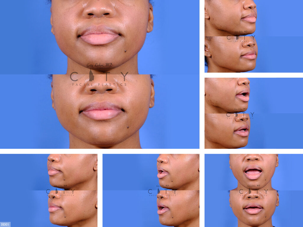 NYC Lip Reduction Before and After Pictures New York UES