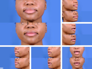 Lip-Reduction-H005_grid