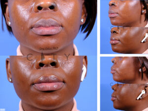 Lip-Reduction-H006_grid