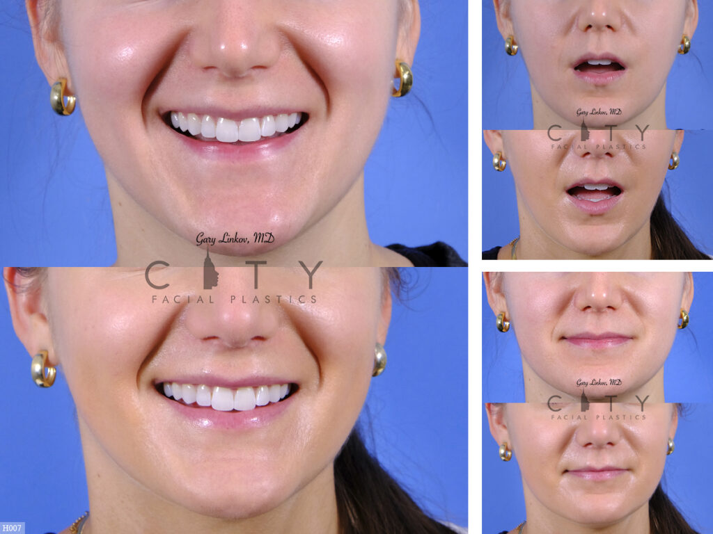 Lip-Reduction-H007_grid