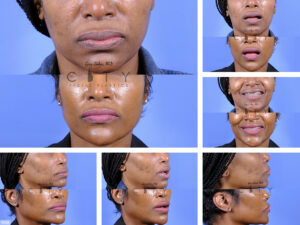 Lip-Reduction-H008_grid