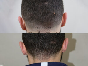 Mole-Removal-I001_grid