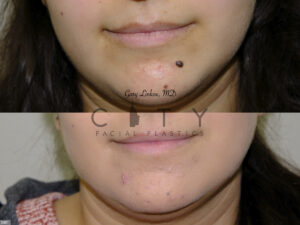 Mole-Removal-I003_grid