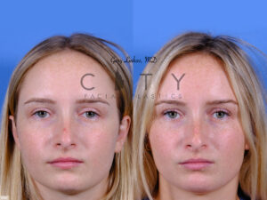 Mole-Removal-I006_grid