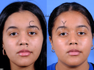 Mole-Removal-I007_grid