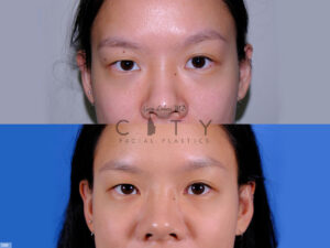 Mole-Removal-I009_grid