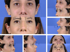 Nasal-Surgery-J003_grid