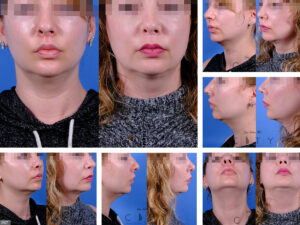 Nasal-Surgery-J007_grid