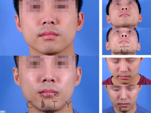 Nasal-Surgery-J009_grid