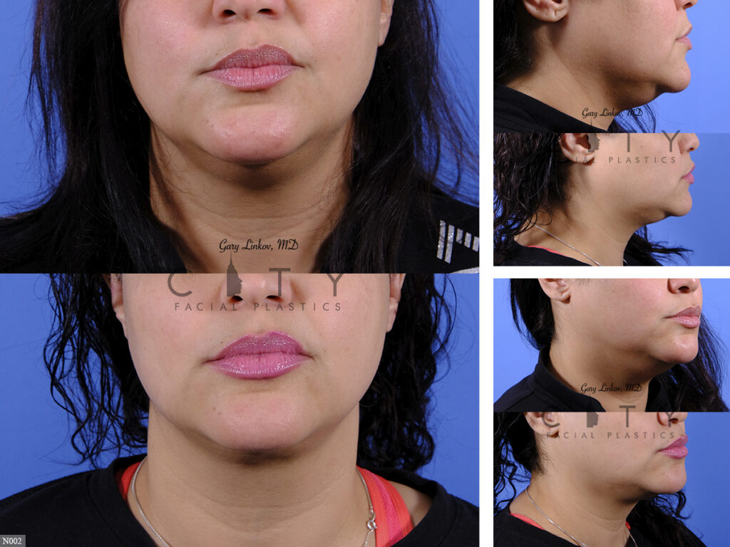 NYC Submental Liposuction Before And After Pictures New York UES