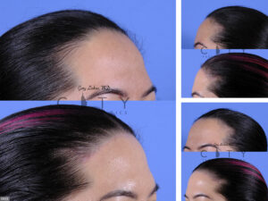 Surgical-Hairline-Advancement-O003_grid