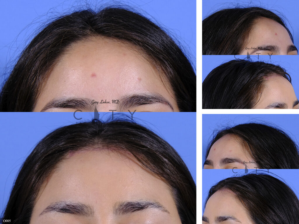 NYC Surgical Hairline Advancement Before and After Pictures New York UES