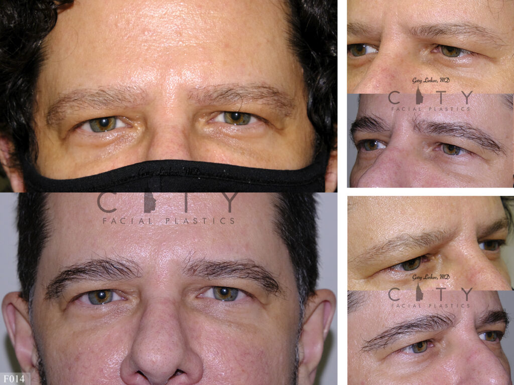 Hair-Transplant-F014_grid