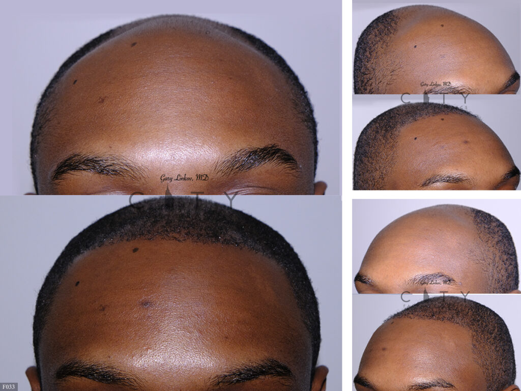 Hair Transplant F033