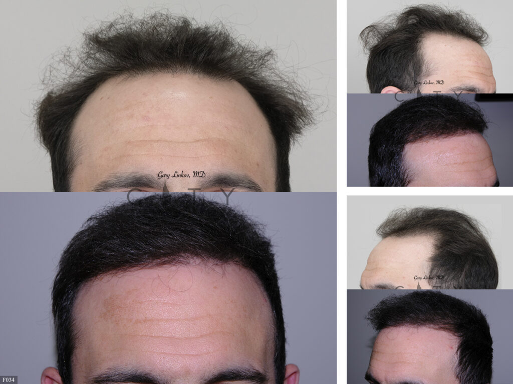 Hair Transplant F034