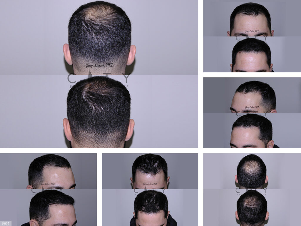 Hair Transplant F037